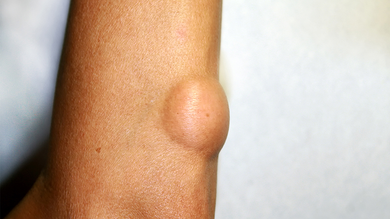 肉瘤為什么要做血藥濃度監(jiān)測?